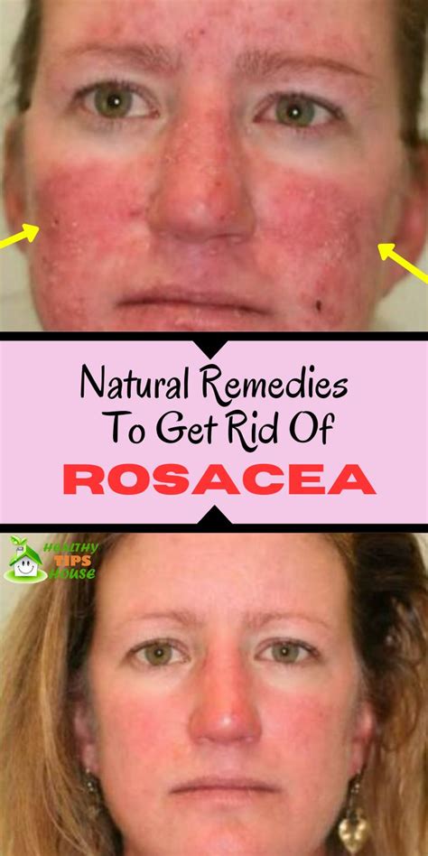 Completely Natural Remedies For Rosacea. | Rosacea, Rosacea skin care, Natural remedies for rosacea