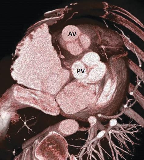 15 Pulmonary Valve | Radiology Key