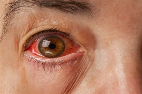 Red Eye: Common Ophthalmologic Disorders in Primary Care