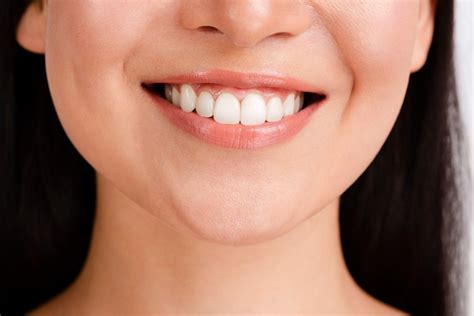 Composite Veneers – Elite Dental Care