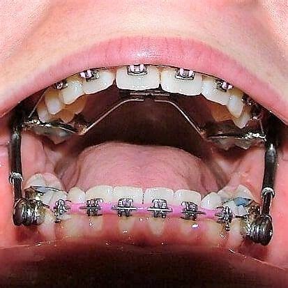 Pin by Nenna Pfuentes on Ortodoncia invisible | Teeth braces, Dental ...