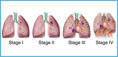 Lung Cancer Staging | Modern Cancer Hospital Guangzhou, China