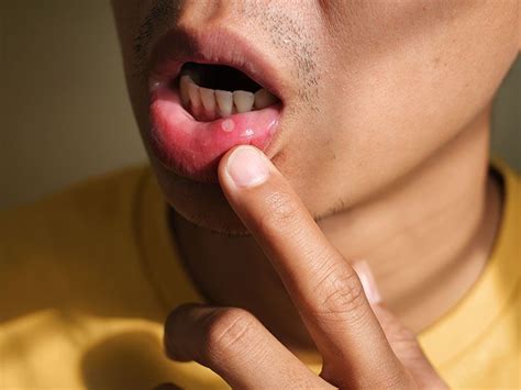 Mouth Ulcer: Causes, Symptoms, Diagnosis, and Treatment