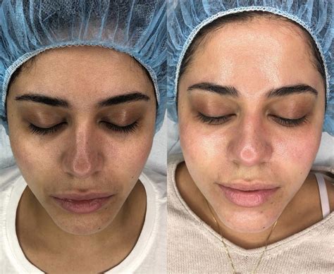 Dermaplaning Boston | Boston Med Spa | Boston Medical Aesthetics