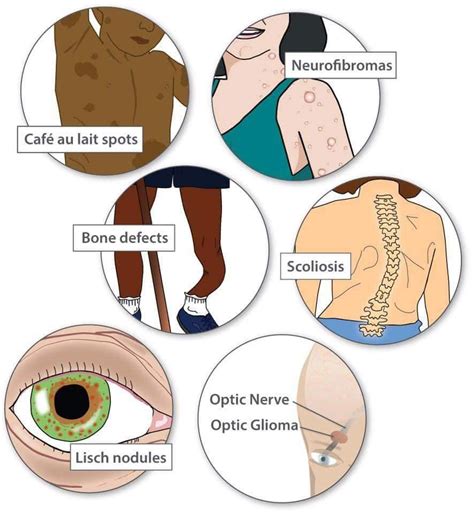 Pin by Shannon Michele on Neurofibromatosis | Neurofibromatosis type 1, Medical laboratory ...