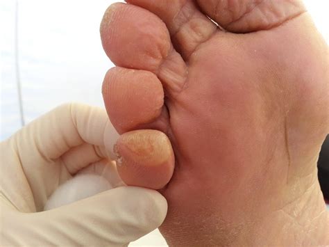 Toe Blister Treatment & Prevention - Blister Prevention