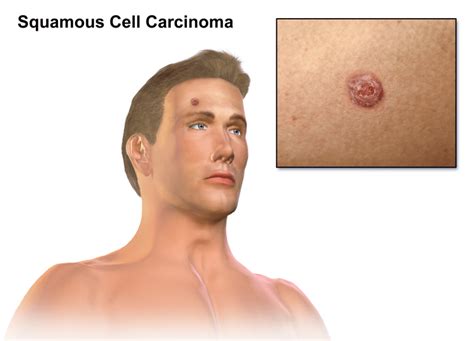 Squamous Cell Carcinoma (Squamous Cell Skin Cancer) - Rochester Hills Dermatologist Dr. Arjun Dupati