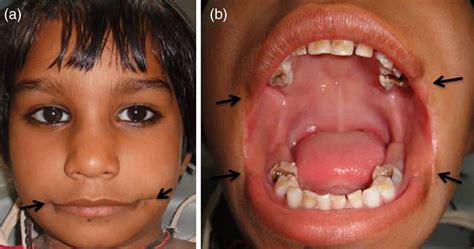 Transverse Facial Cleft