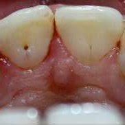 The clinical palatal view shows prominent palatal cingulum with... | Download Scientific Diagram