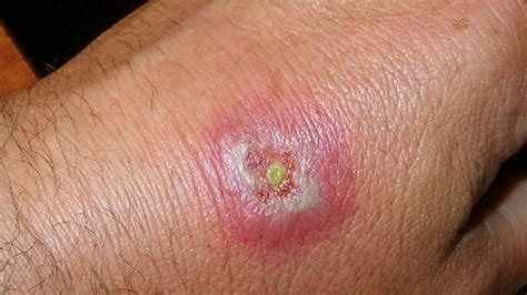Diagnosis and treatment of spider bites - New Star Pest Control UAE