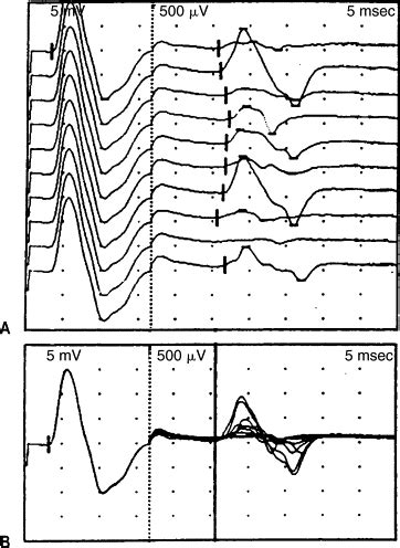 H-Reflex and F-Response Studies | Neupsy Key