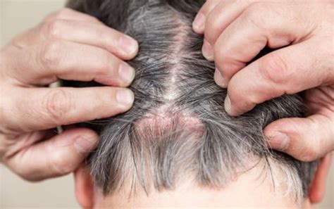 Causes of Scalp Scabs and How to Treat Them - Flipboard