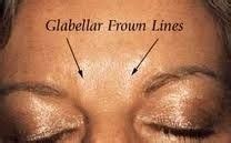 Facial Toning Advice Using Facial Gymnastics Exercises: Homemade Non-Invasive Brow Furrow ...