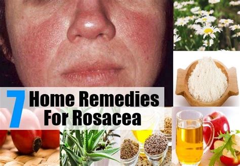 7 Home Remedies For Rosacea | Home remedies for rosacea, Rosacea, Natural remedies for rosacea