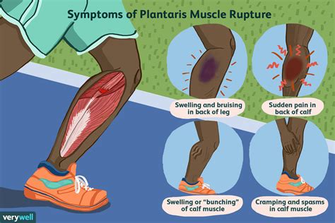 Plantaris-Muskelrisse und Wadenschmerzen