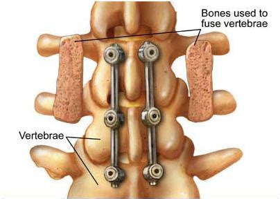 What is Spinal Decompression Surgery? - Dr. James Manzanares