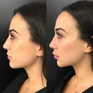 Cheek Filler Brisbane | Cheek Dermal Fillers and Biostimulator Injections