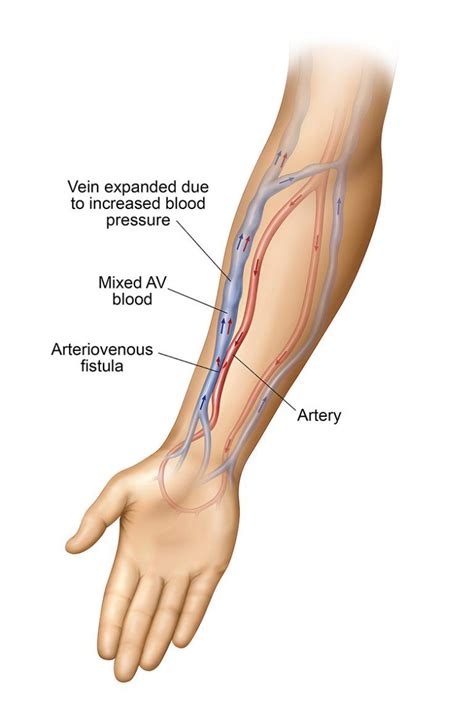 AV Fistula Creation for Dialysis | AV Fistula Placement