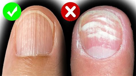 Ridges In Nails - Causes Of Nail Ridges And How To Treat Them - YouTube