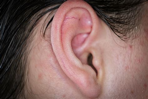 10 Tips to Prevent & Treat Pimples in the Ear - eMediHealth