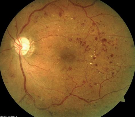 Dot And Blot Hemorrhages