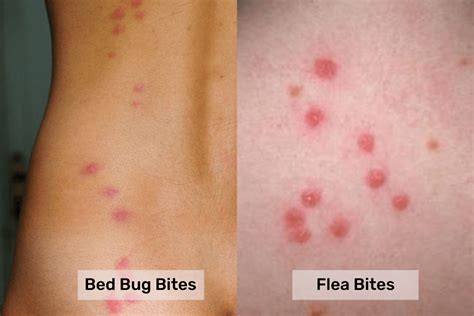Bed bugs bite vs. Flea Bite: What's the Difference? - Pest Control Gurus