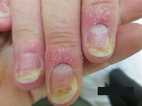 Details 120+ clobetasol propionate nail psoriasis best - ceg.edu.vn