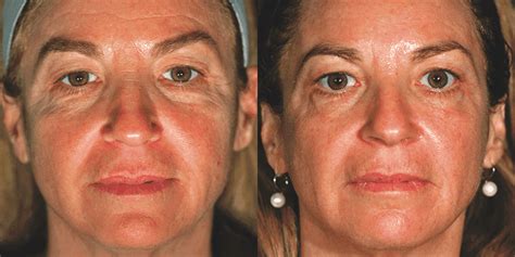 Pelleve Wrinkle Reduction & Skin Lifting