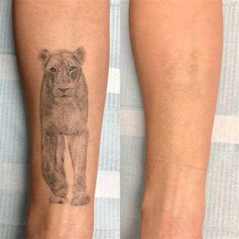 Các phương pháp laser tattoo removal an toàn và hiệu quả nhất hiện nay