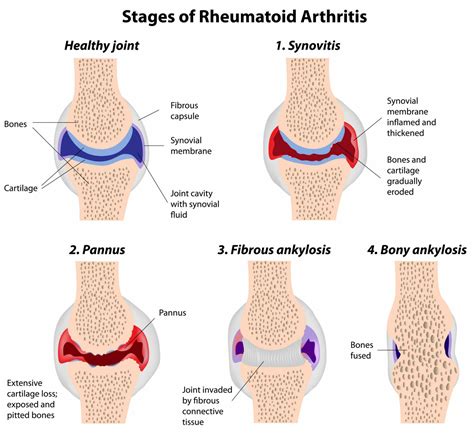 Stages of rheumatoid arthritis | Physio-logical