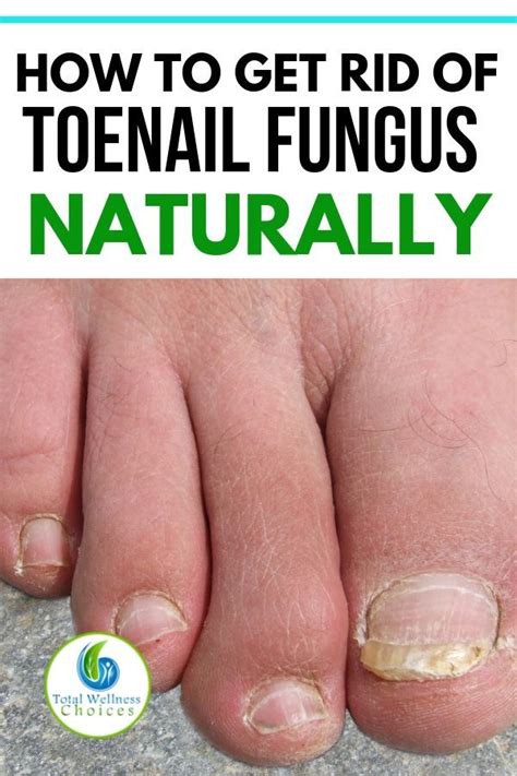 9 Best Natural Home Remedies for Toenail Fungus | Toenail fungus remedies, Natural toenail ...