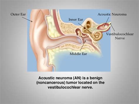 What is acoustic neuroma?