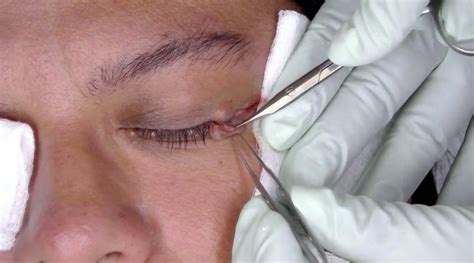 Dr. Pimple Popper treated a woman with bumps around her eyes - Business Insider