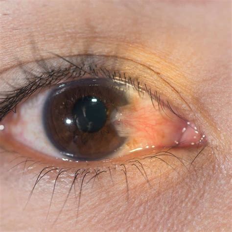 Common Eye Diseases Vision Loss Resources - vrogue.co
