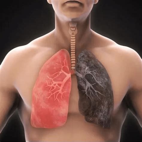 Understanding Chronic Obstructive Pulmonary Disease (COPD): Symptoms ...