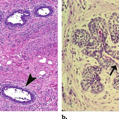 Galactocele in a 15-year-old girl that was confirmed by aspiration of... | Download Scientific ...