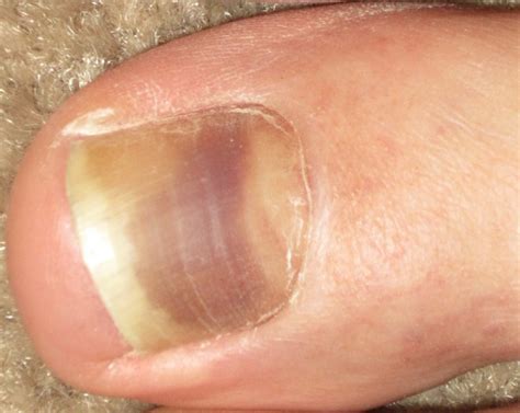 Toenail discoloration: causes, risks and ways to treat discolored toenails | Toe nail ...