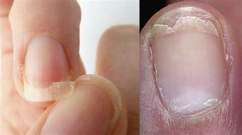 Top 10 Most Common Nail Diseases & Disorders - ProMed Clinic