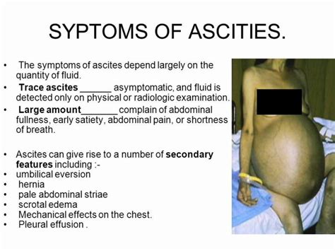 Ascites Symptoms | MedicineBTG.com