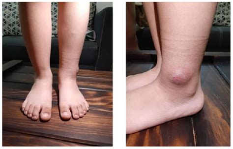 Swelling and redness on the lateral malleolus of the left ankle. | Download Scientific Diagram