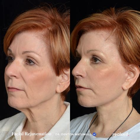 12 Facelift Recovery Tips to Know | Facelift recovery, Face lift ...