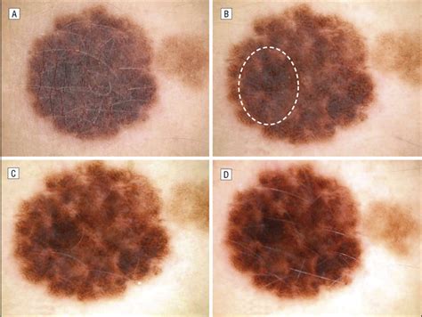 A dysplastic nevus shown by clinical photography (A), nonpolarized ...