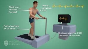 Stress Electrocardiogram (Stress ECG) - Ballarat Cardiology