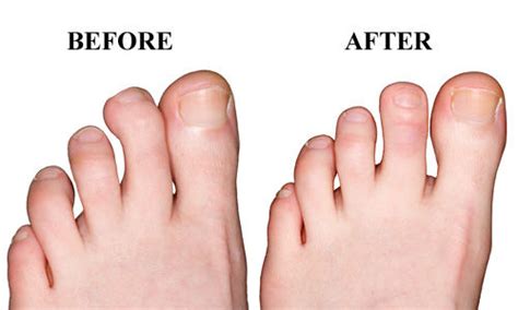 Schedule a Hammer Toe Surgery in Chicago, IL - Keyes for Toes