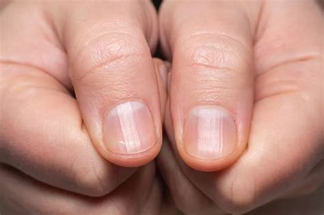 What ridges in your nails really mean – and when it's time to go ...