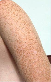 Freckles On Arms ~How to fade freckles @ http://meladermpigmentreducingcomplex.org/is-meladerm ...