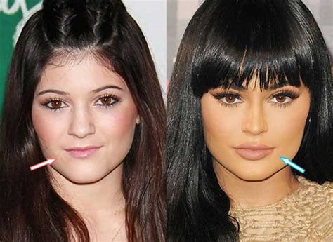 Before And After Surgery Pics Of Kylie Jenner