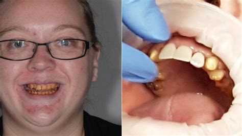 New Zealand Woman suffering from enamel hypoplasia debuts amazing teeth transformation | 7NEWS