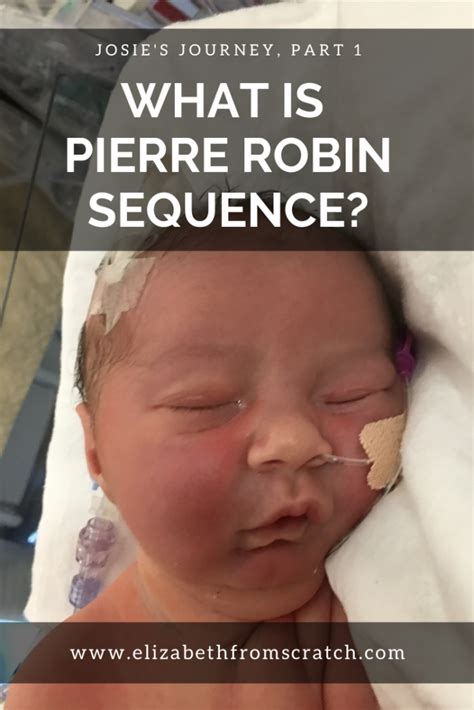 Pierre robin sequence in utero - networkingwery