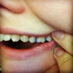 Orthodontic Spacers - The Blog of Jess